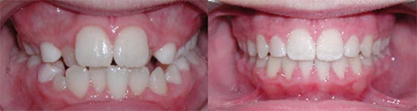 This young patient has significant crowding issues. When there is a mix of baby teeth and permanent teeth, early intervention with space gaining and space holding appliances made all the difference in allowing all the permanent teeth to be aligned without extraction of permanent teeth. Waiting for all the permanent to erupt in this case would have required extractions of permanent teeth.