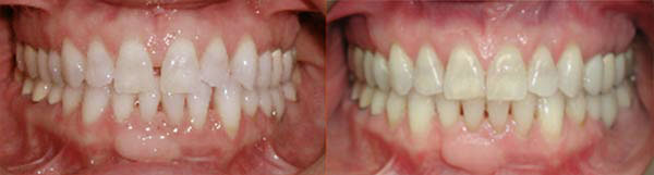 An adult patient wanted all spaces to be closed. Invisalign was the appliance that accomplished this goal.