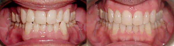 Although this adult patient previously had orthodontic treatment as a child, relapse of the correction occurred over time. Realignment was accomplished with Invisalign. Night time retention is recommended to hold the correction.