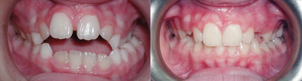 When the width of the upper arch is to narrow in relationship to the width of the lower arch, a simple appliance called a palate expander can make this correction in a growing child.<br />

This 8 year old patient shows a dental crossbite of the left back teeth and a tongue thrust kept the front teeth from correctly erupting. The palate expander alone normalized this patients bite.
