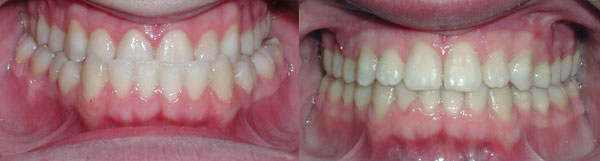 This adult patient demonstrates what can occur when there is a discrepancy in jaw growth. The upper jaw did not grow forward enough in relationship to the lower jaw and required both braces and corrective jaw surgery to create a normal bite for this patient.