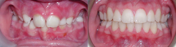 Today there are many options to save permanent teeth when a patient comes to the orthodontist early. Although, there are circumstance when the size of the teeth are to large for the size of the jaws. In this instance, extraction of permanent teeth became necessary in order to achieve this beautiful smile.