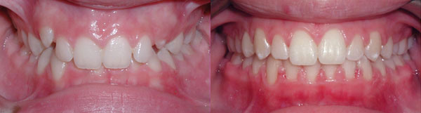 This patient shows a deep dental bite, where the upper front teeth excessively overlap the lower front teeth. When such a bite remains and is not corrected, the result is excessive wear of the lower front teeth as a result of normal jaw function. A full set of braces corrected the deep bite and allowed for ideal tooth guidance with normal jaw function.