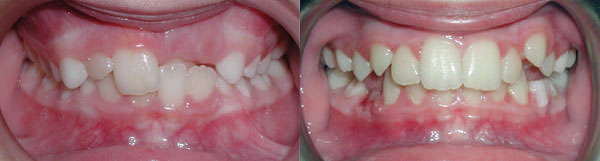 This patient presented with a single front tooth in crossbite. She was traumatizing the tooth and required an initial phase of orthodontic treatment to jump this front tooth over the bottom teeth. Removable appliances were used to accomplish the correction. A second phase of treatment will be required to finalize her smile. I was thankful for a cooperative patient who is now happily smiling again!